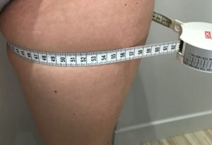 cuisses cryolipolyse médicale